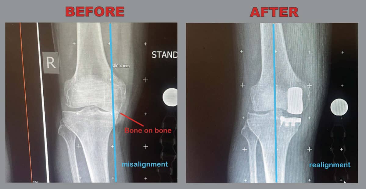 Alameda Post - a before and after x ray from a knee surgery