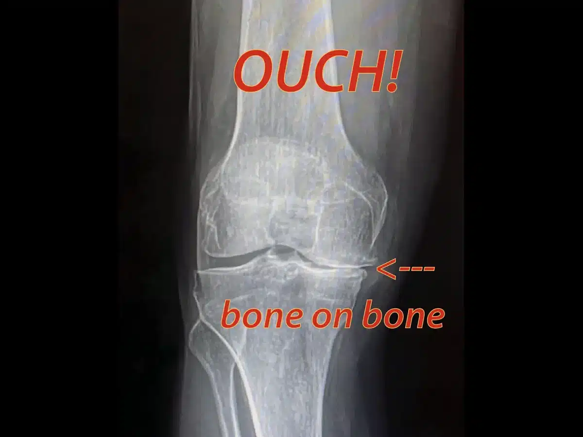 Alameda Post - x-ray of a knee