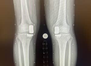 Alameda Post - An xray of two knees showing matching hardware inside.