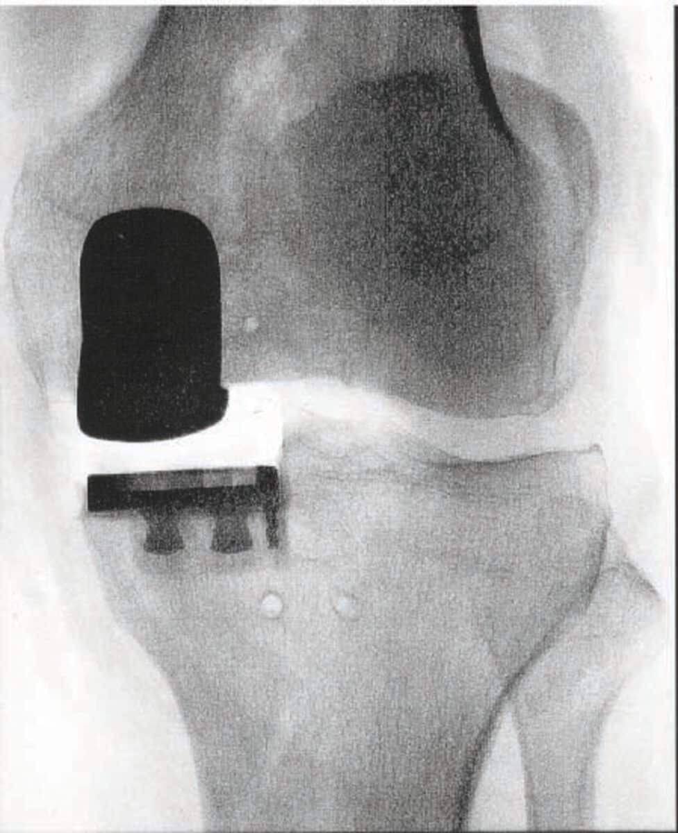 Alameda Post - An xray of a knee with hardware in it.