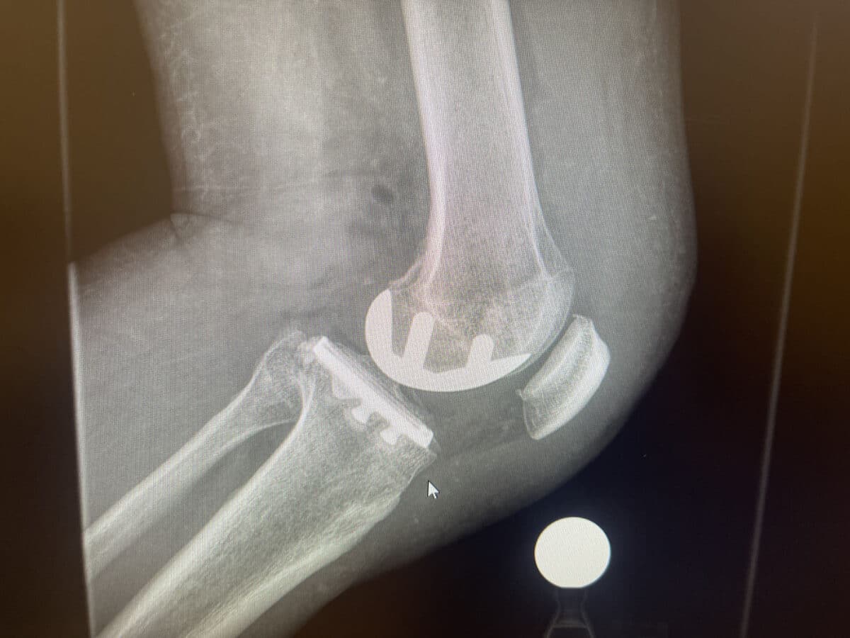 Alameda Post - An xray of one bent knee with hardware inside. 