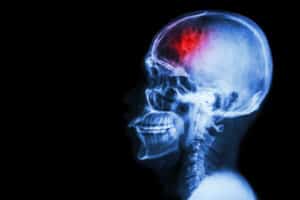 Alameda Post - An xray of a head and neck with a red blur in the skull.