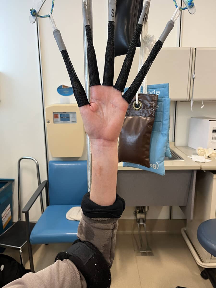 Alameda Post - A woman's hand suspended by individual finger holders. The wrist is visibly wonky and bruised. A strap is wrapped below her bent elbow, applying pressure to help straighten the hand.