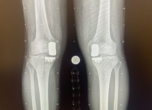 Alameda Post - An xray of two knees showing matching hardware inside.